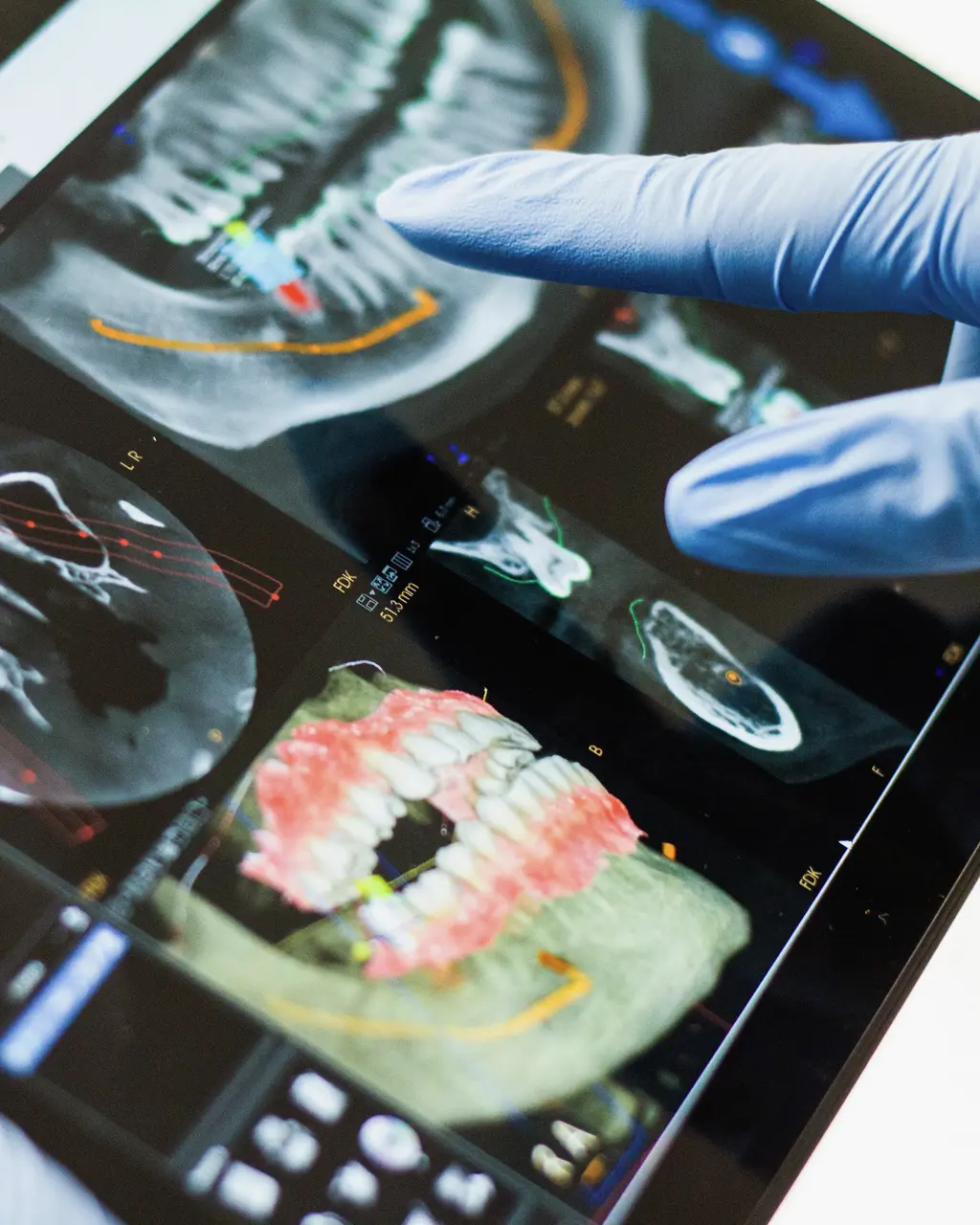 A gloved hand pointing at a dental scan on a tablet